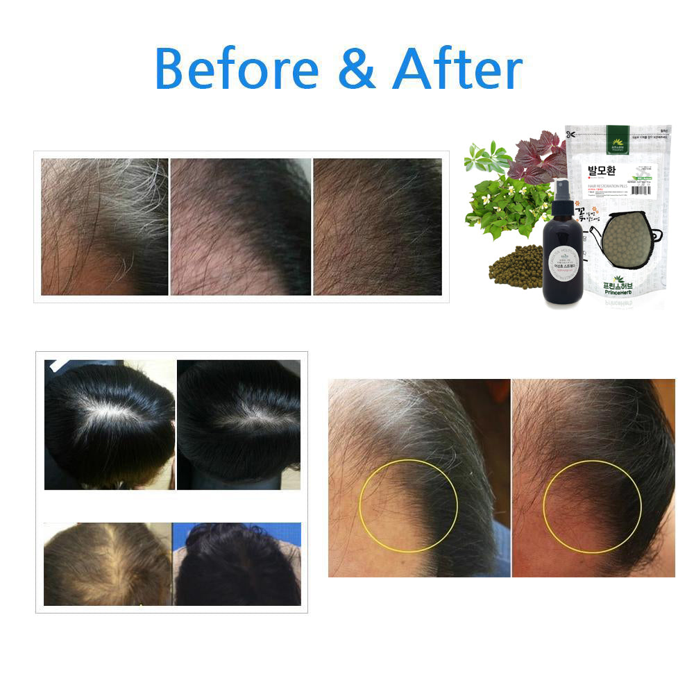 Hair Restoration SET 100% Natural Hair Restoration Spray + Pills | [한국산] 발모환 & 발모팩 세트